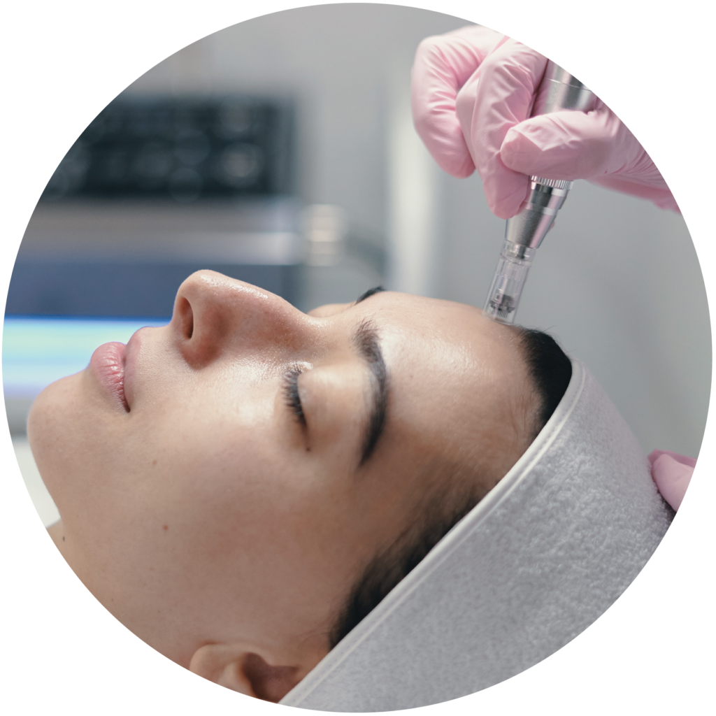 microneedeling